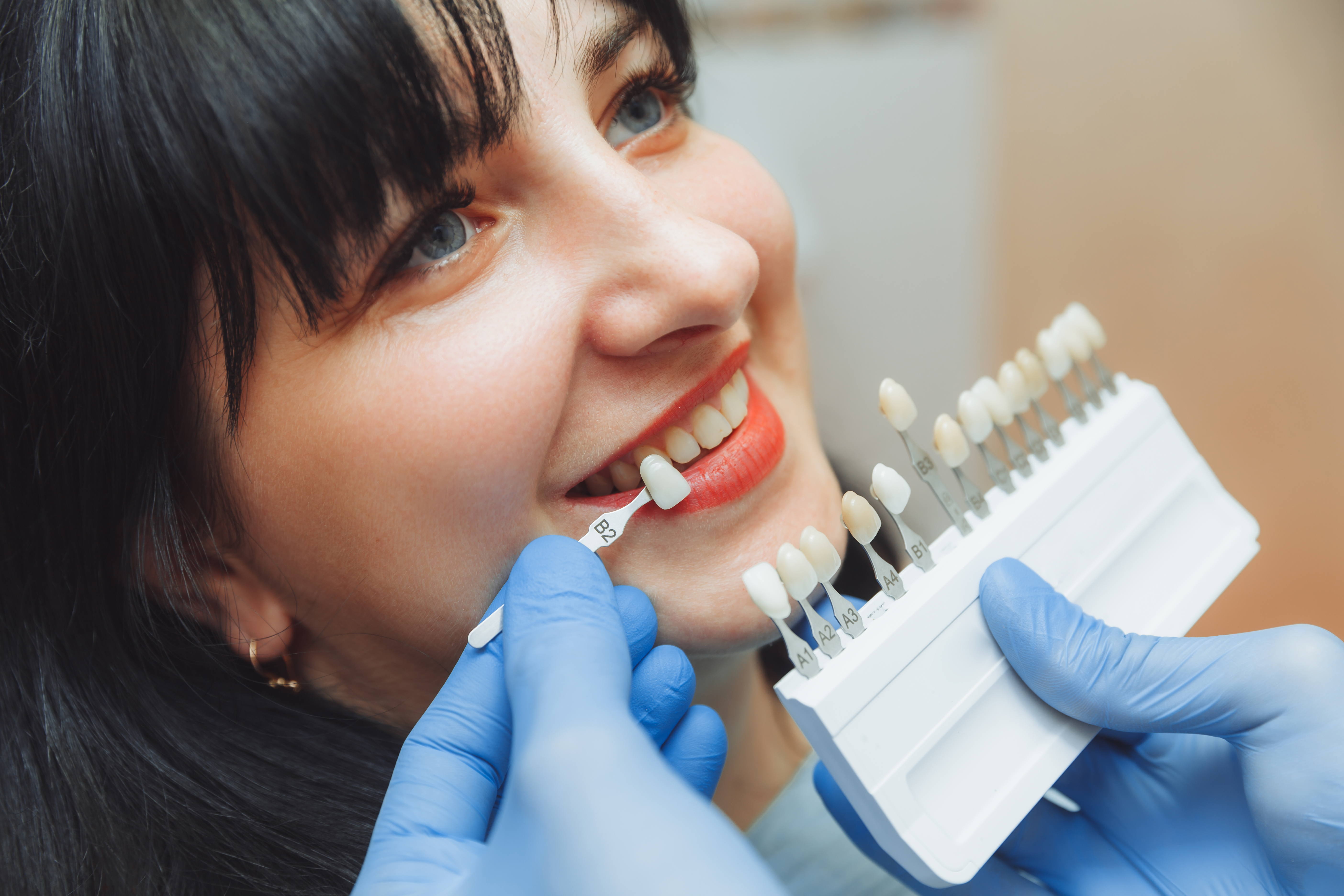 Porcelain veneers